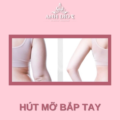 Có nên hút mỡ bắp tay? Chi phí hút mỡ tay, bắp tay là bao nhiêu?