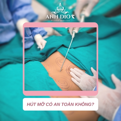 Hút mỡ có an toàn không? Những rủi ro có thể gặp phải khi hút mỡ