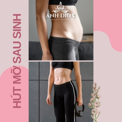 Hút mỡ sau sinh có hiệu quả? Sau sinh bao lâu thì thực hiện được?
