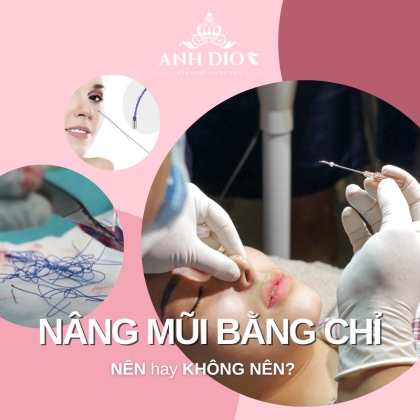 Nâng mũi bằng chỉ là gì? Có nên thực hiện? Giá nâng mũi chỉ