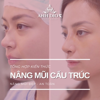 Nâng mũi cấu trúc giá bao nhiêu? - Sự thật về nâng mũi 4D, 5D, 6D, 8D
