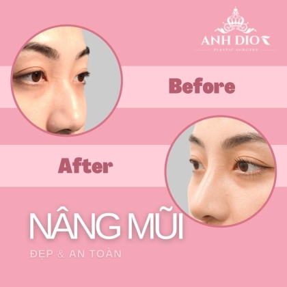 Nâng mũi: 6 phương pháp và 10+ điều cần biết để ĐẸP, AN TOÀN