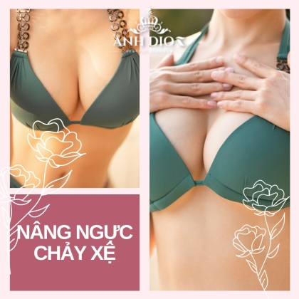 Nâng ngực chảy xệ - phương pháp nào là TỐT và AN TOÀN nhất?