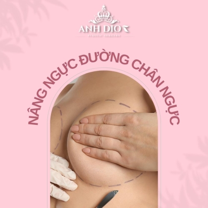 Nâng ngực đường chân ngực - Đường nâng ngực phổ biến nhất hiện nay