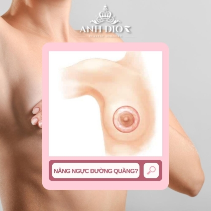 Nâng ngực đường quầng có tốt không? - Ưu điểm, nhược điểm 