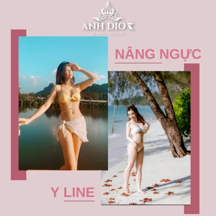 Ngực Y line là gì? Nâng ngực Y line giá bao nhiêu?