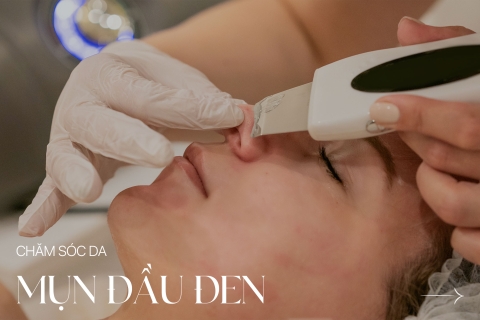 Chăm sóc da mụn đầu đen