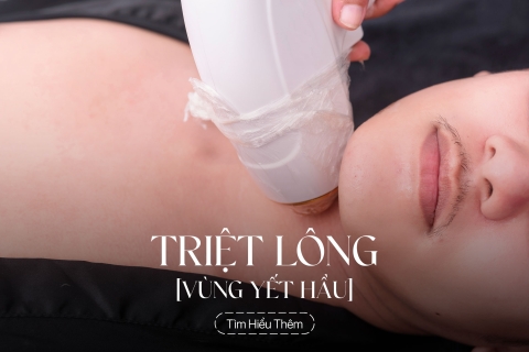 Triệt lông vùng yết hầu