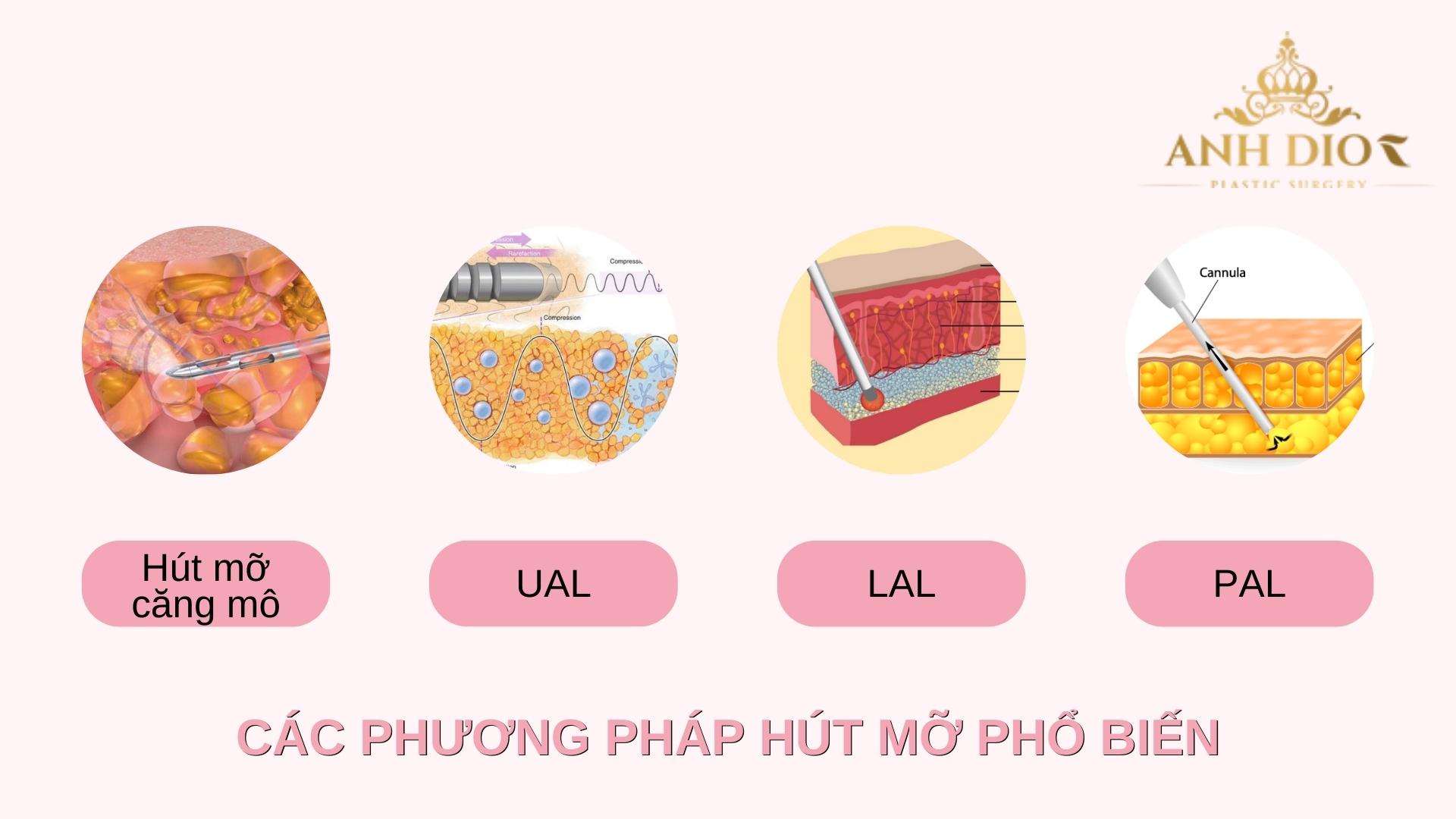 Công nghệ hút mỡ hiện đại nhất