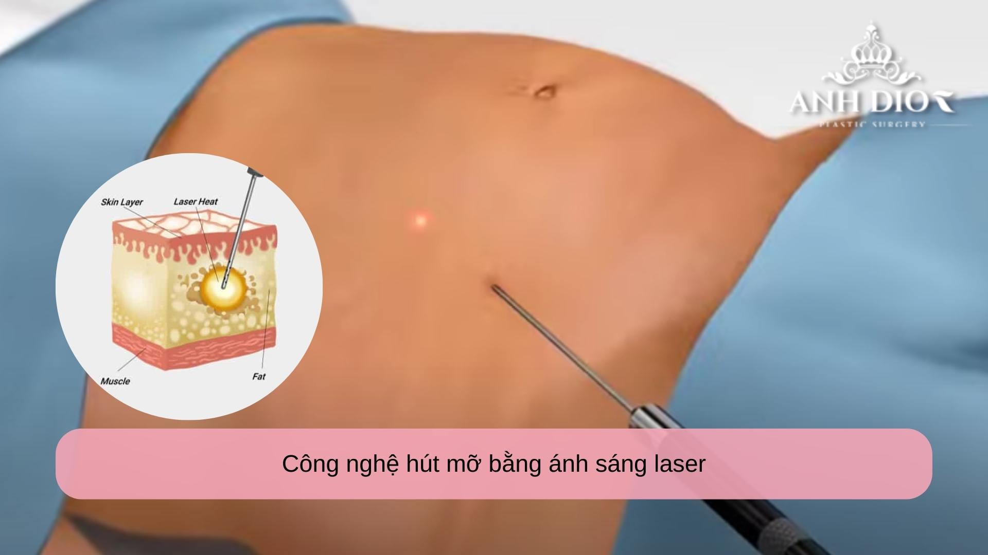 Công nghệ hút mỡ hiện đại nhất