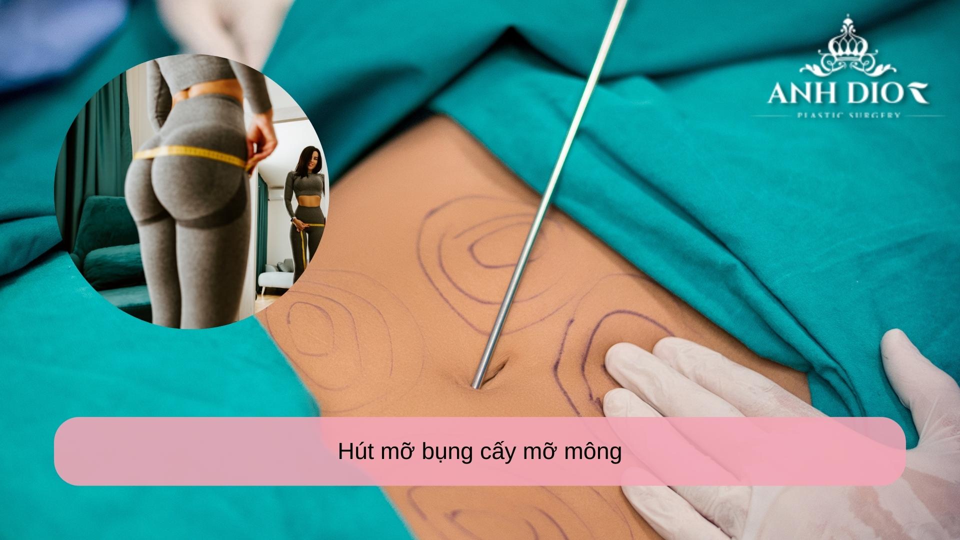 Hút mỡ bụng cấy mỡ mông