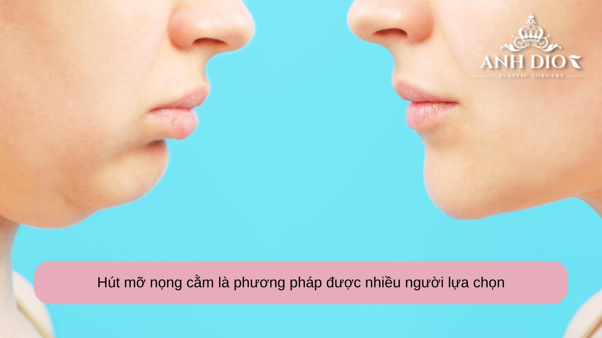 Hút mỡ nọng cằm