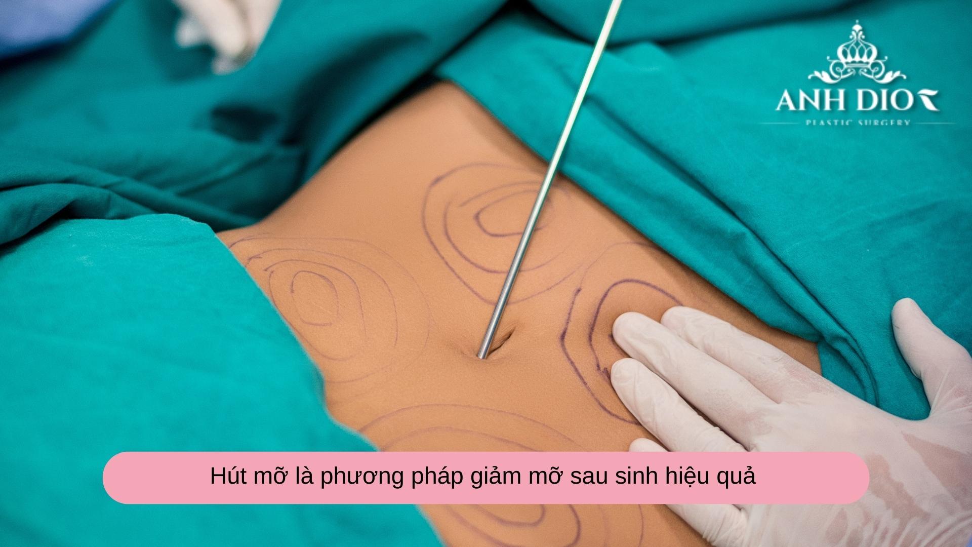 Hút mỡ sau sinh