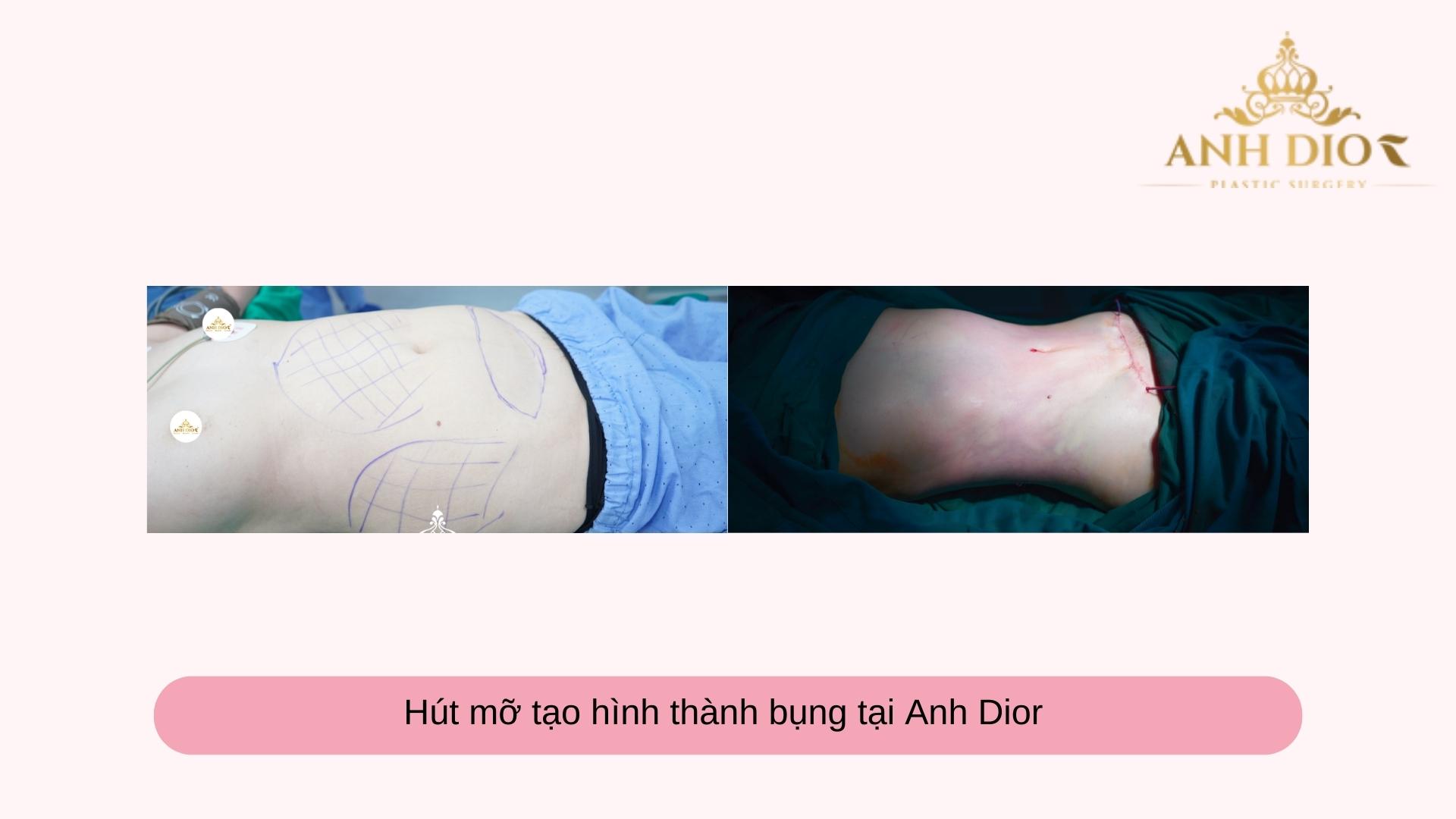 Hút mỡ tạo hình thành bụng 