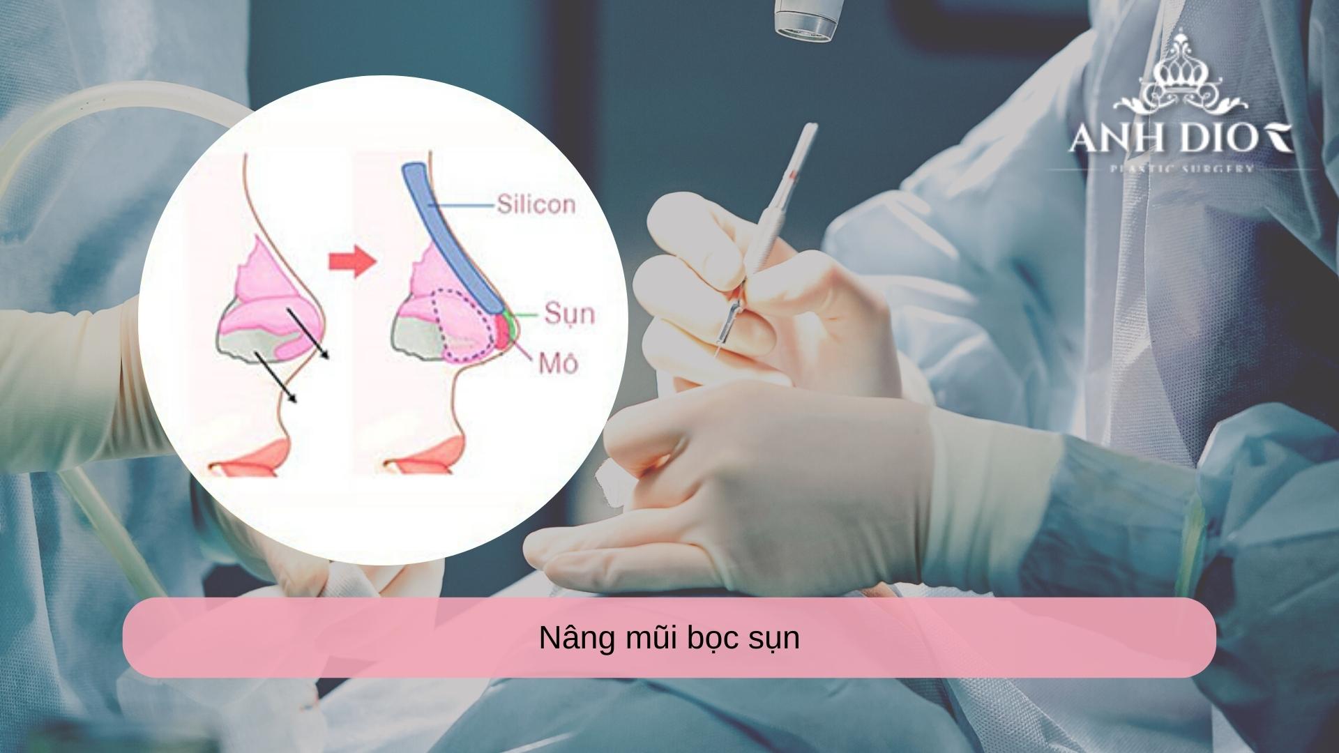 Nâng mũi bọc sụn