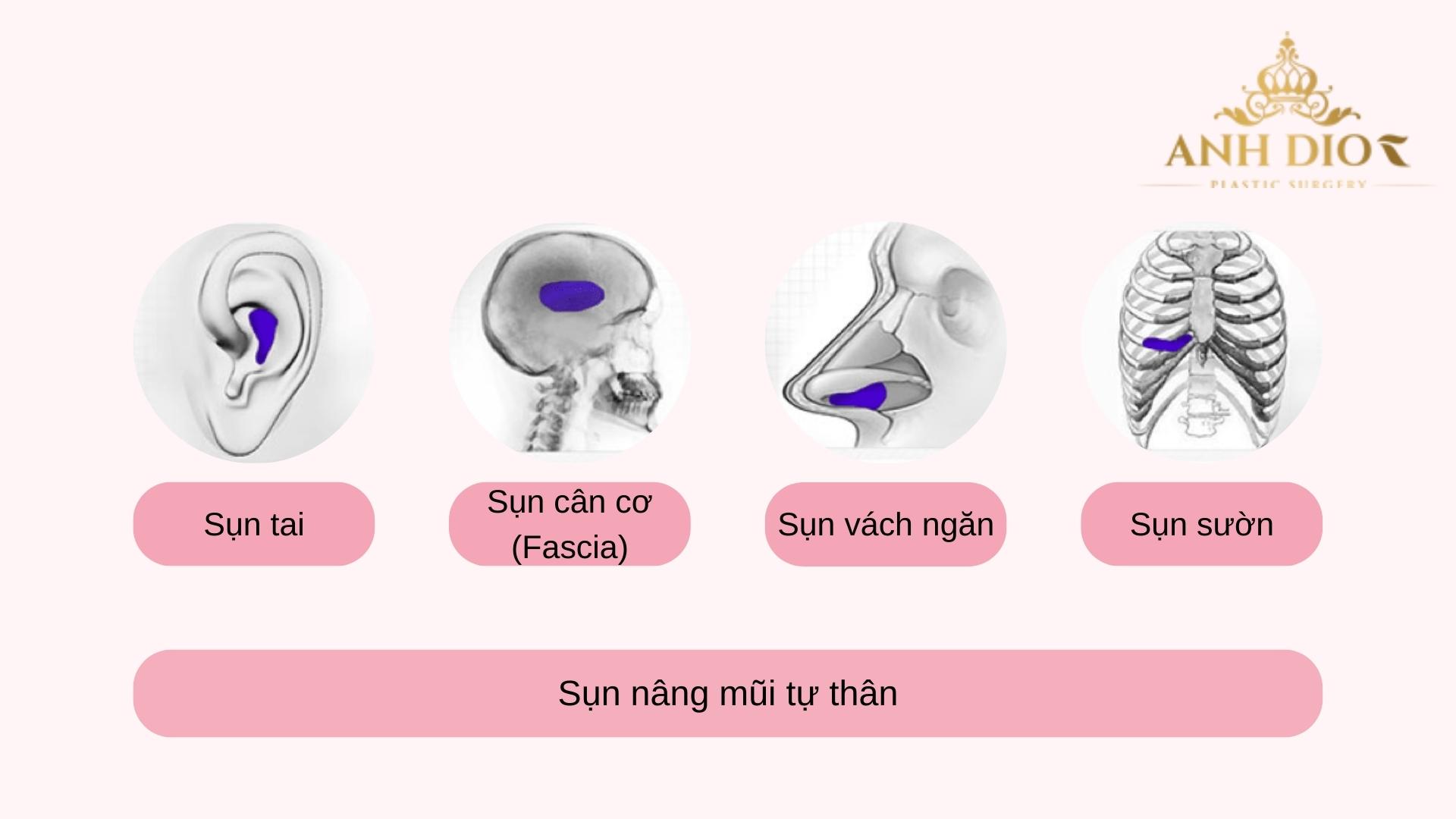 Các loại sụn nâng mũi