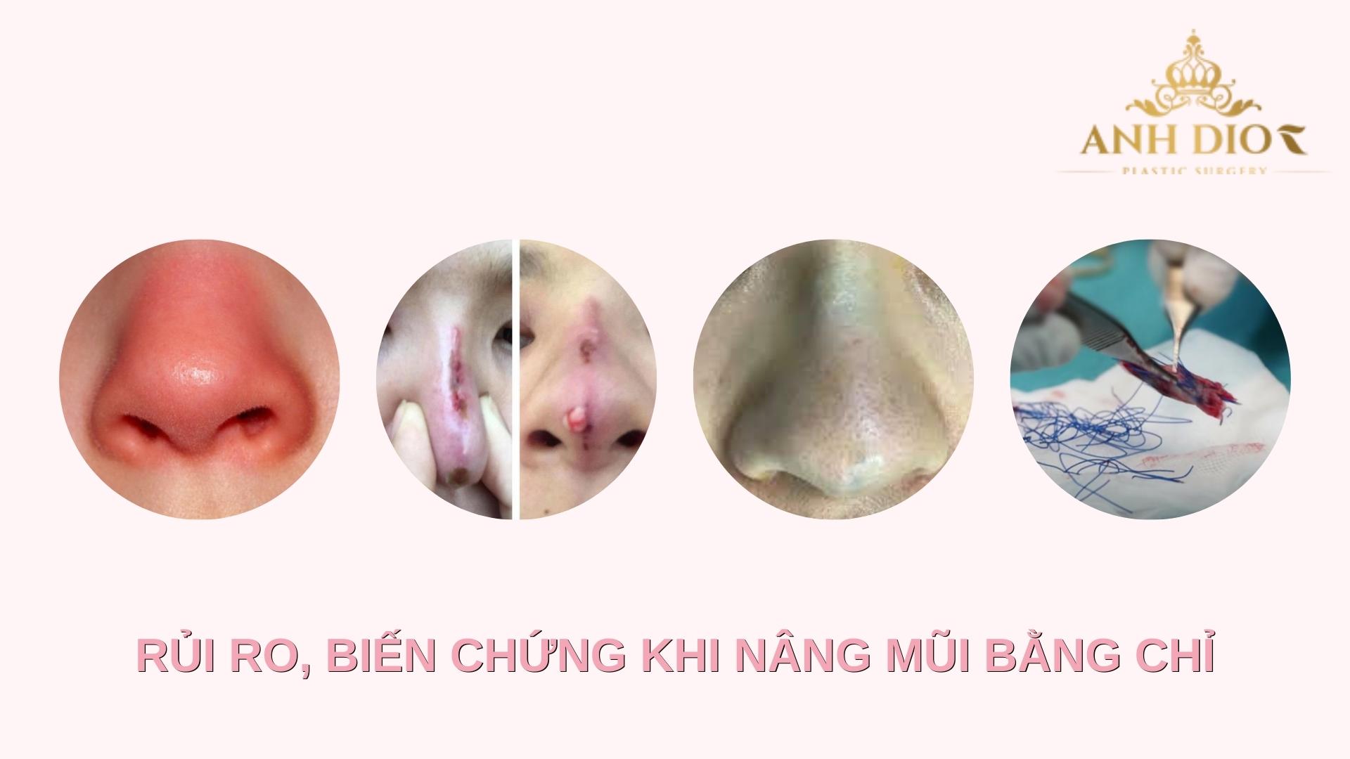 Biến chứng nâng mũi bằng chỉ