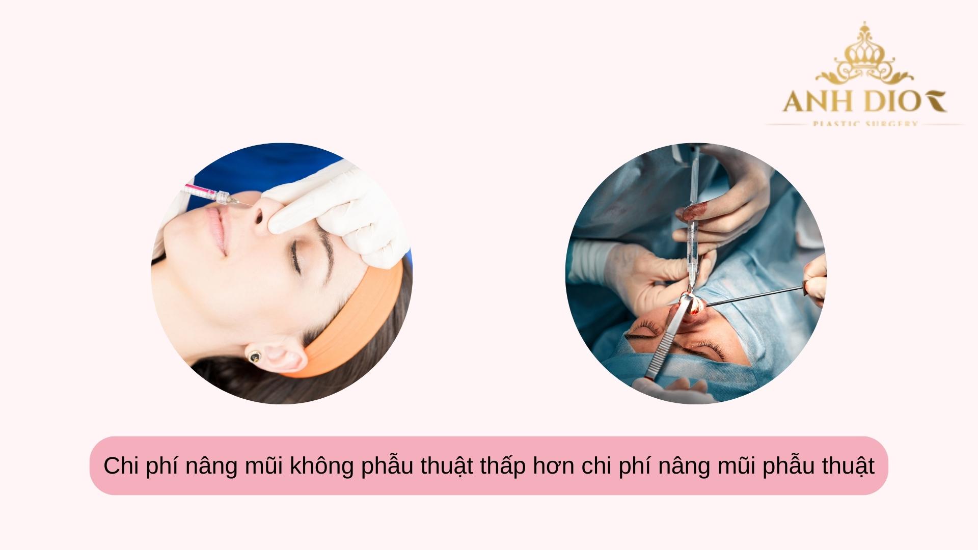 Nâng mũi bao nhiêu tiền