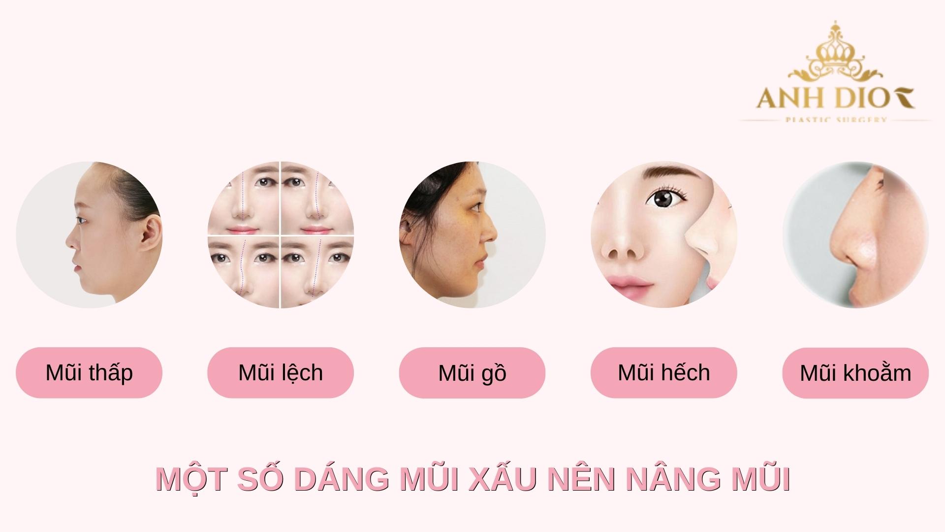 Nâng mũi đẹp, an toàn