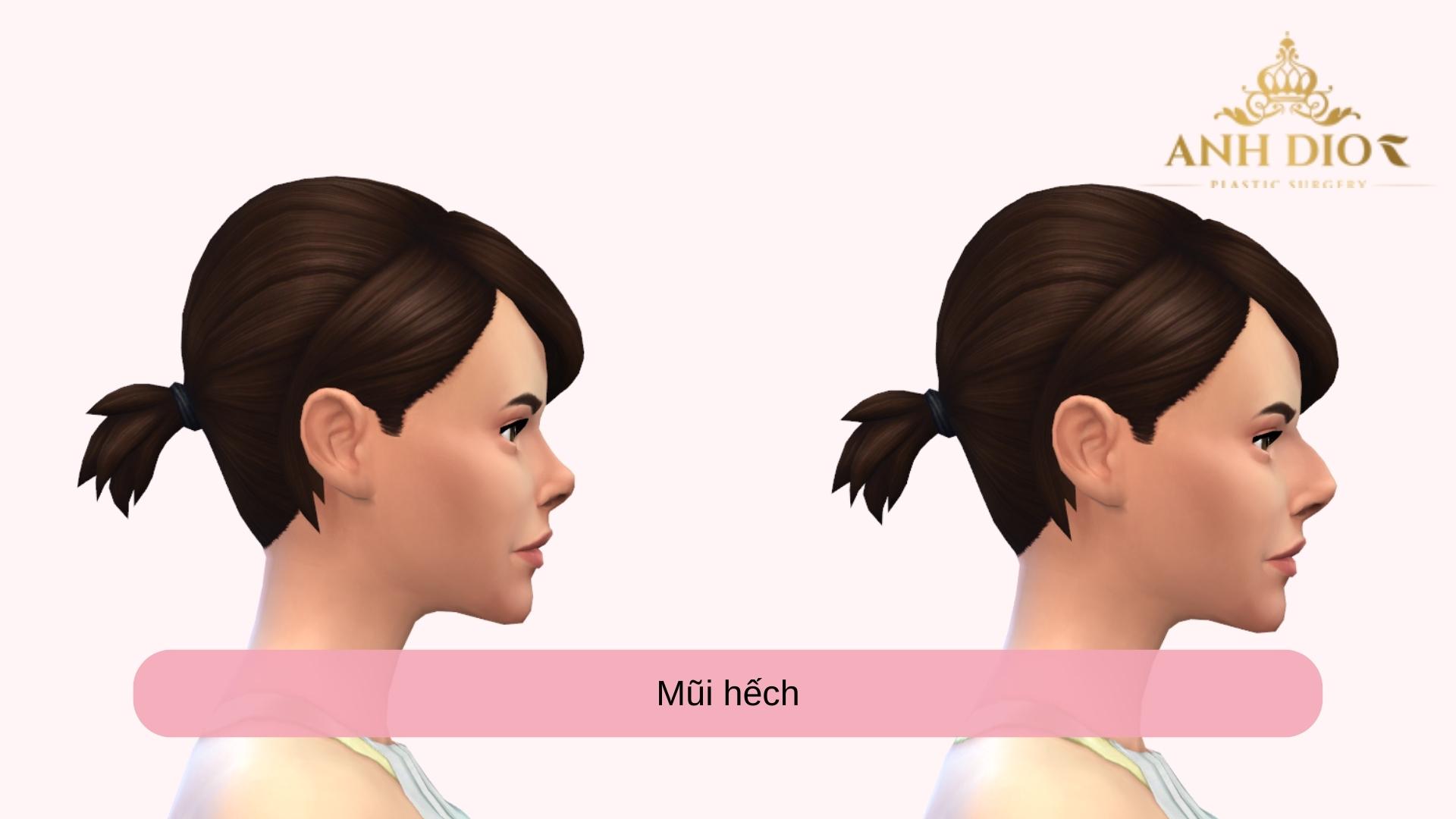 Nâng mũi hếch