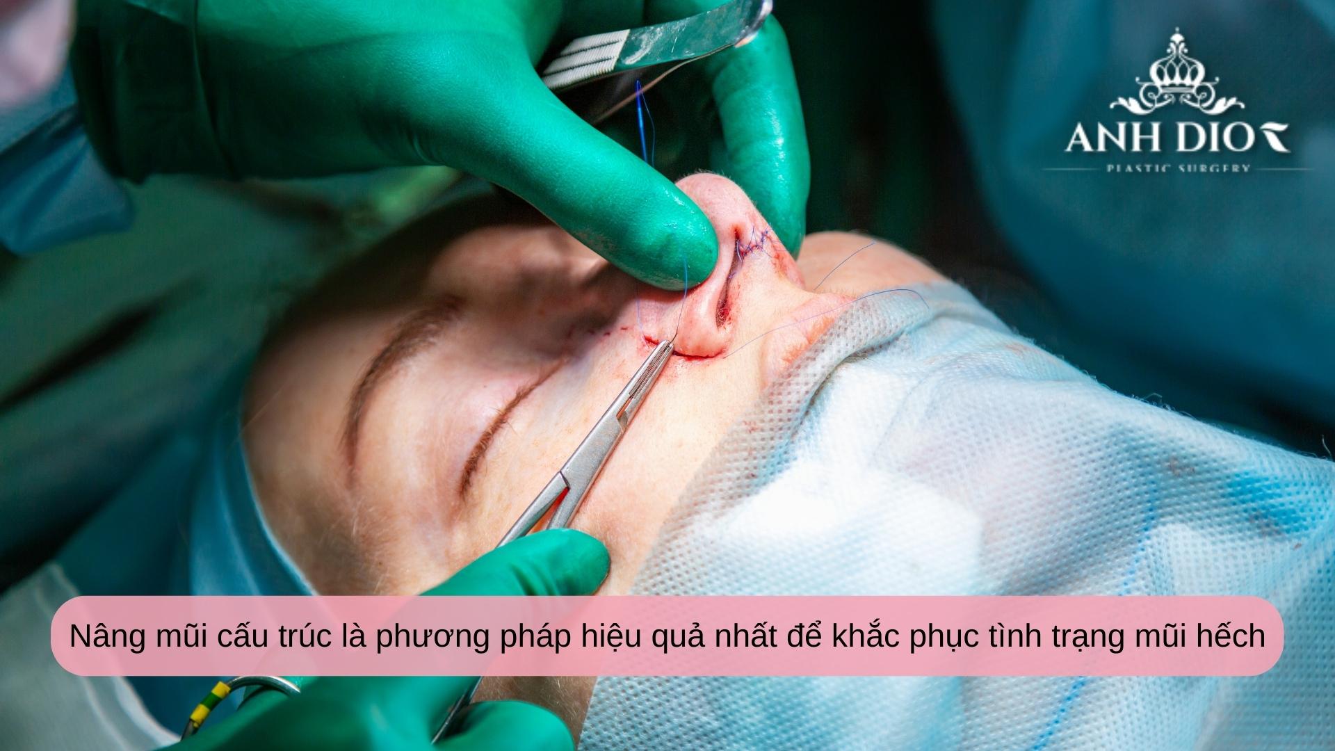 Nâng mũi hếch