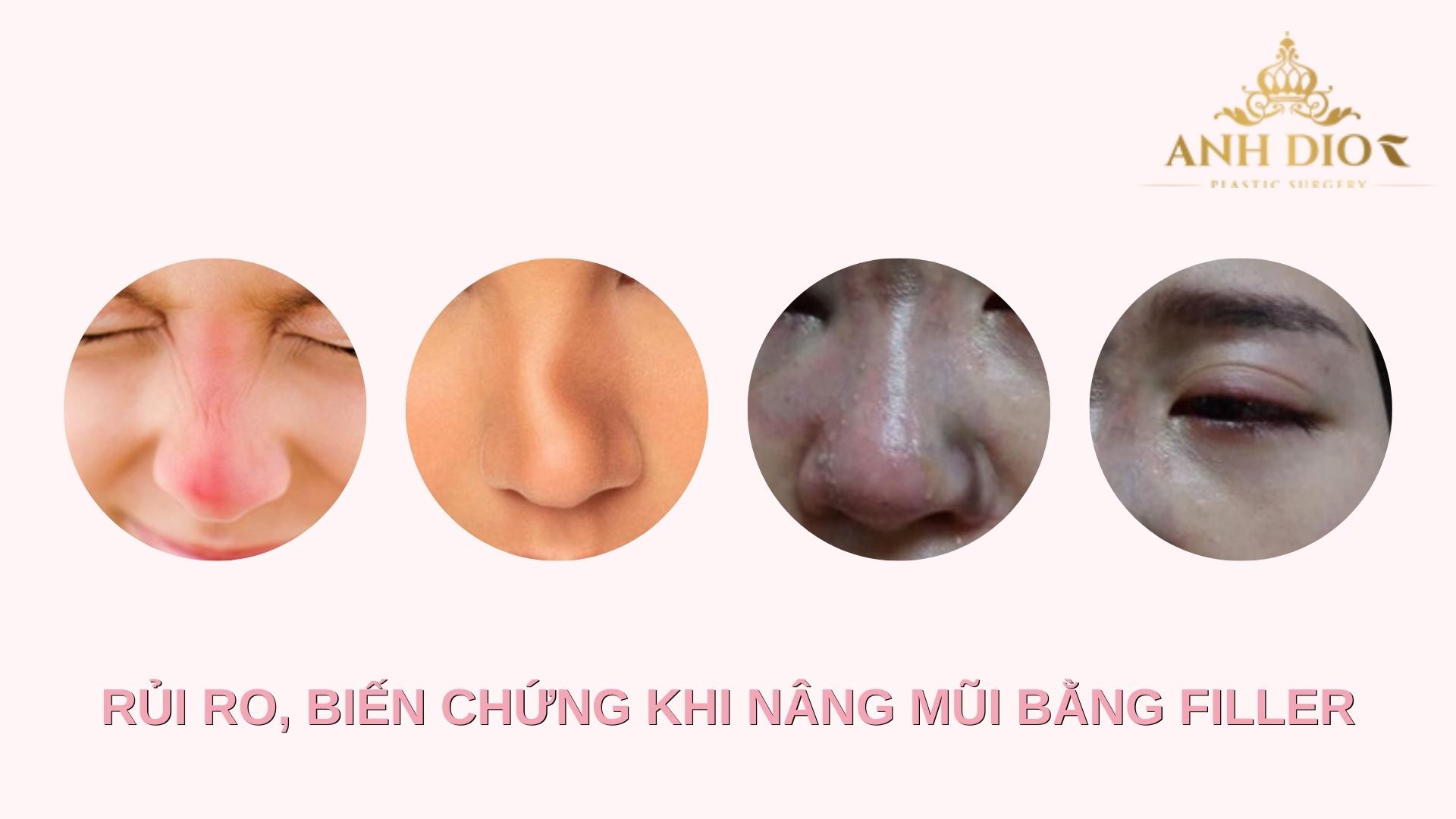 Nâng mũi không phẫu thuật