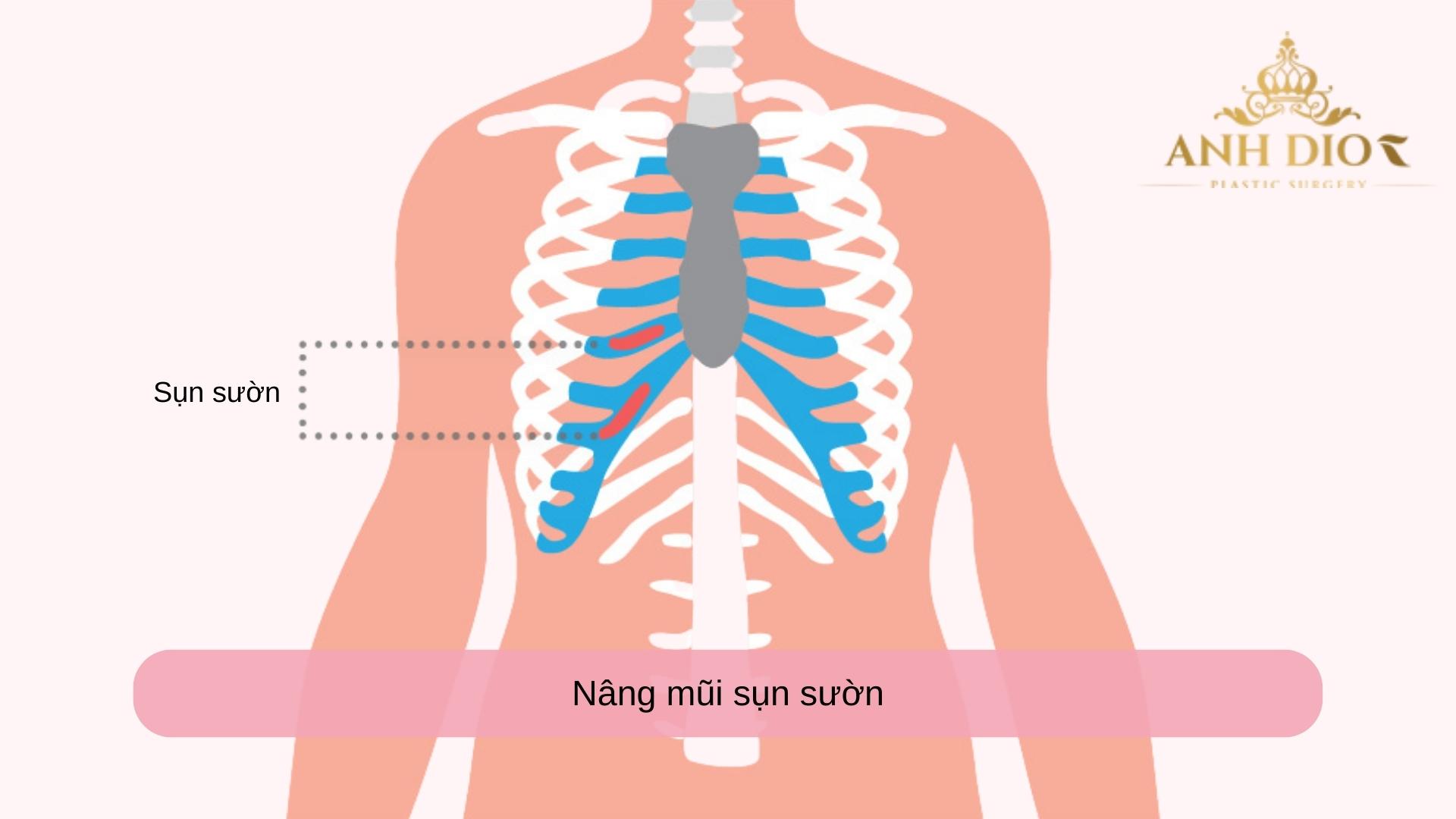 Nâng mũi sụn sườn