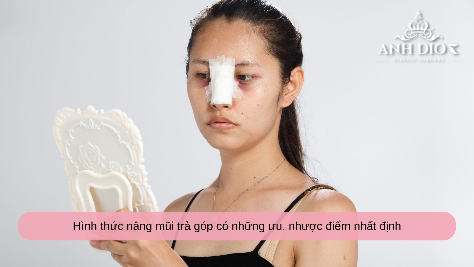 Nâng mũi trả góp