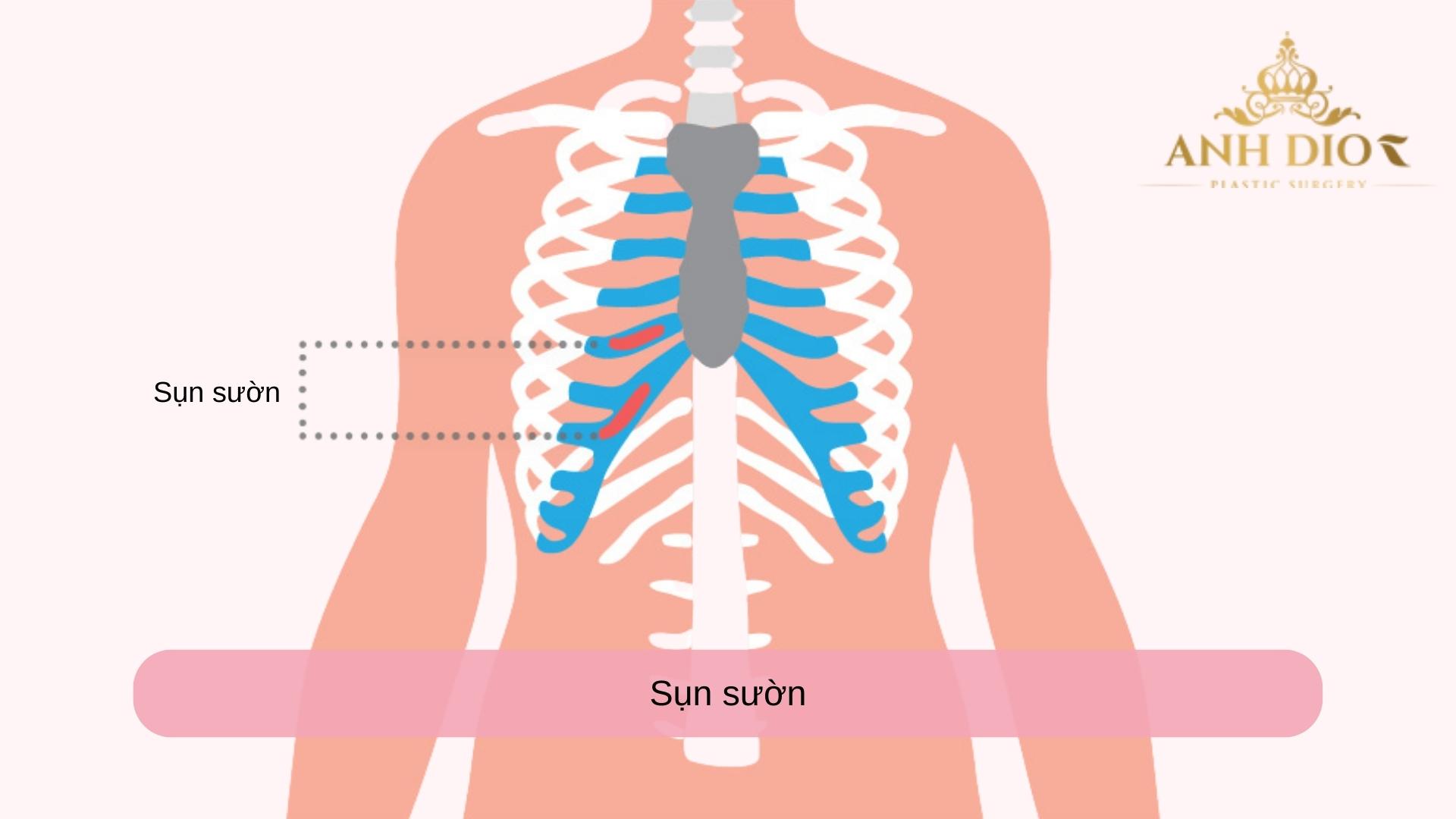 Nâng mũi tự thân