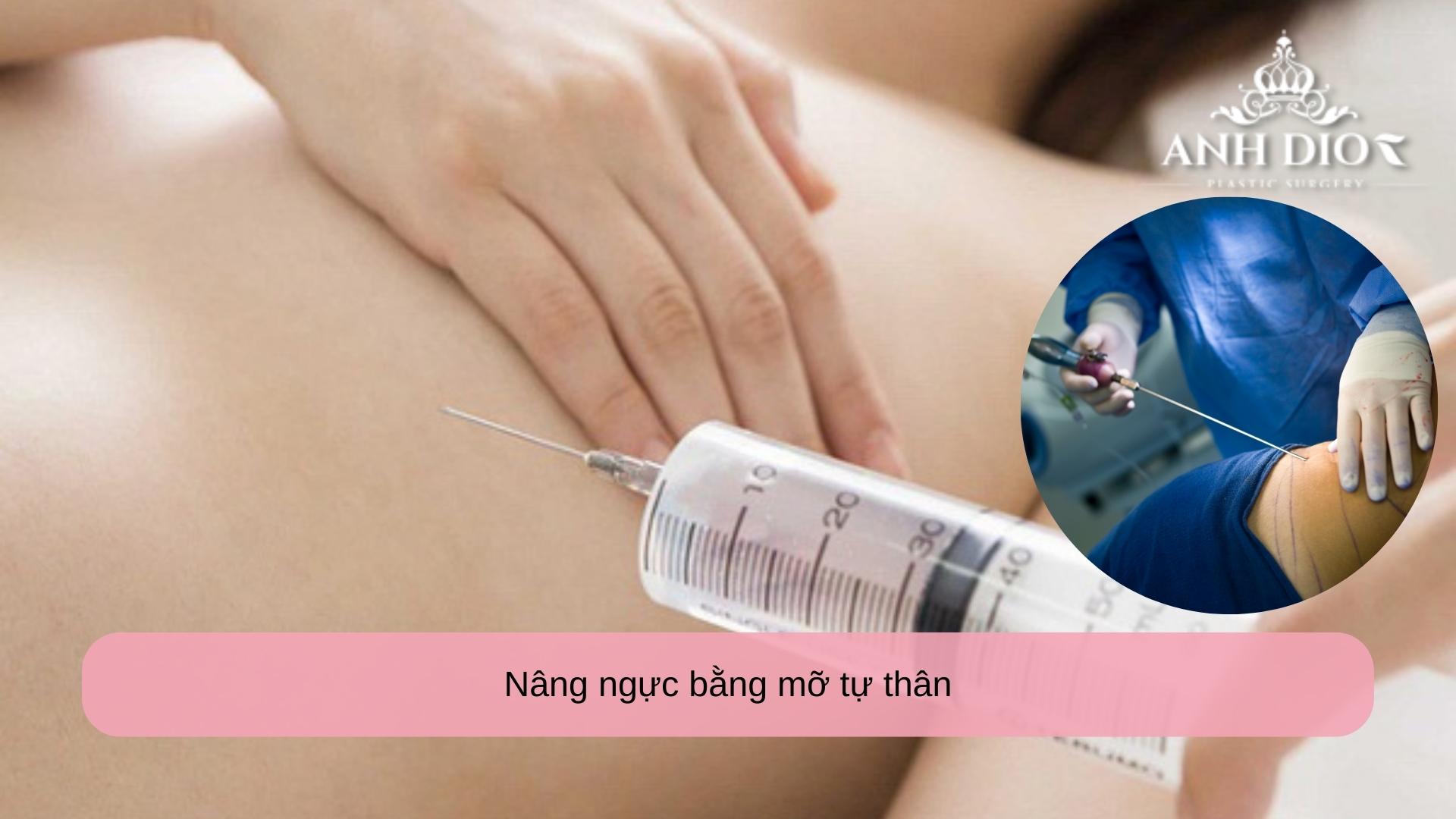 Nâng ngực bằng mỡ tự thân