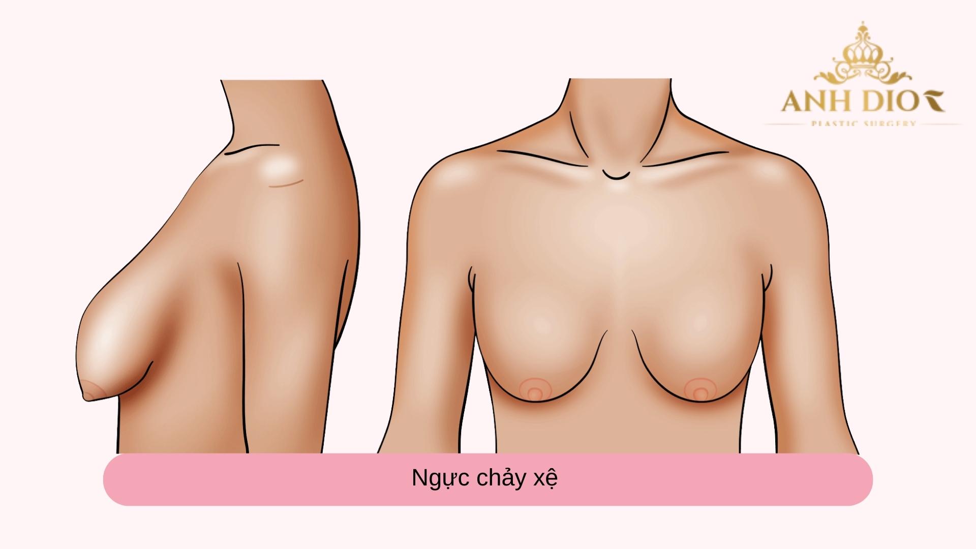 Nâng ngực chảy xệ