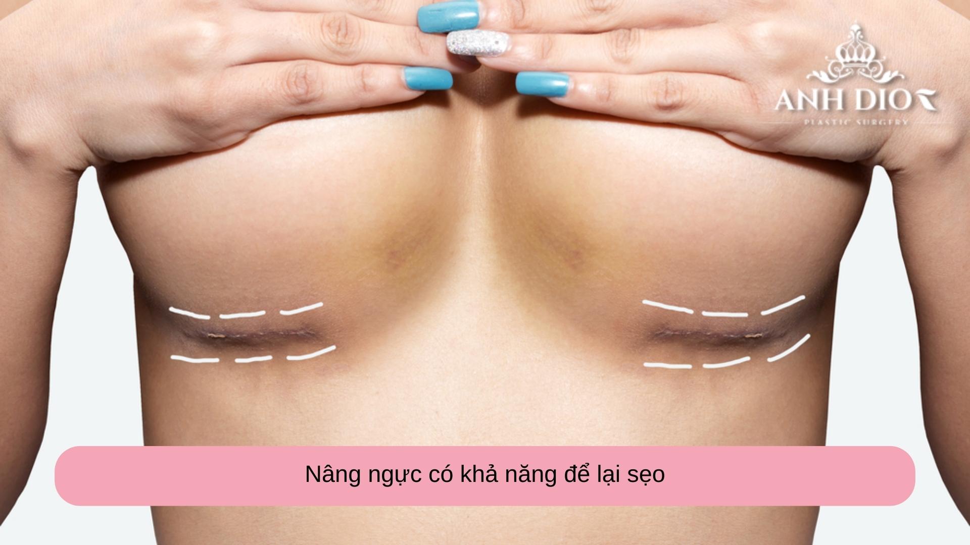 Nâng ngực có để lại sẹo không