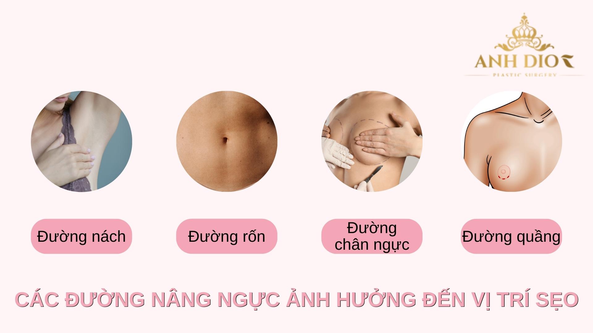 Nâng ngực có để lại sẹo không