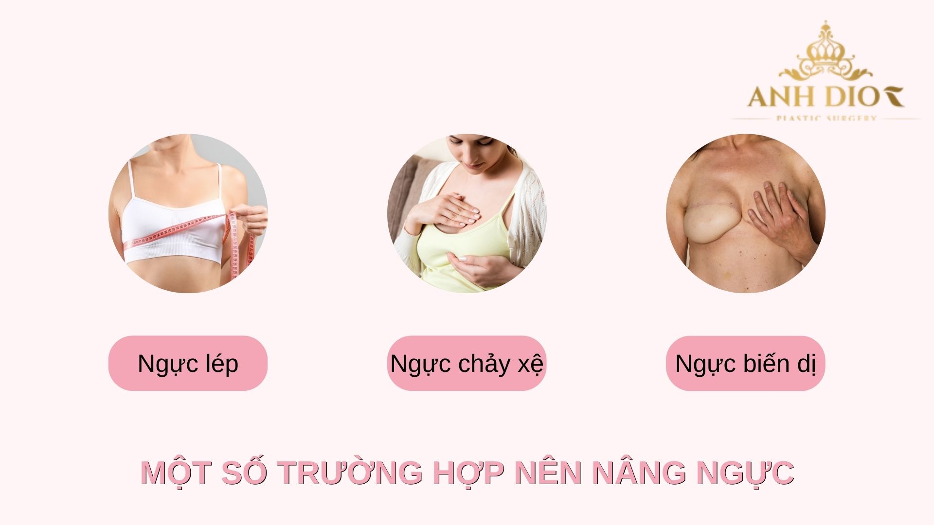 Các trường hợp nên nâng ngực