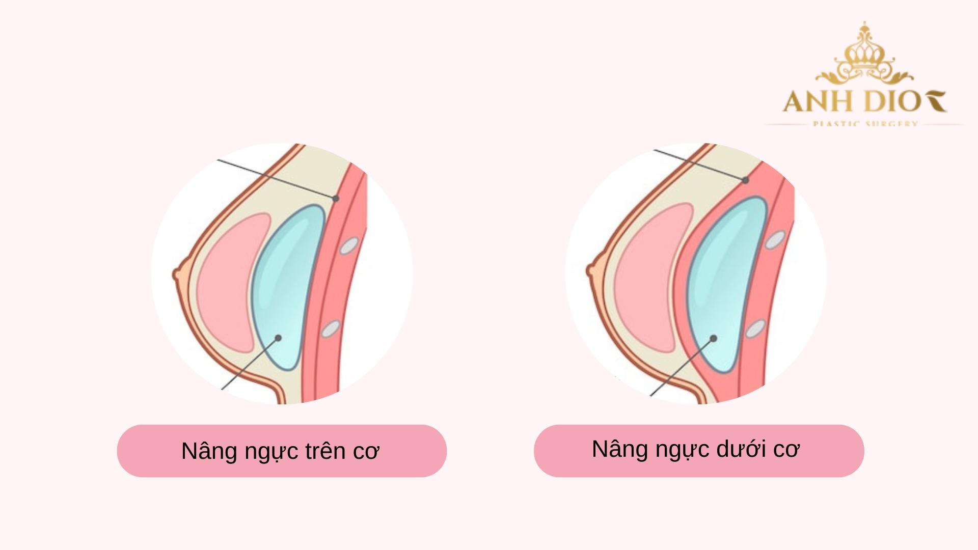 Nâng ngực dưới cơ hay trên cơ