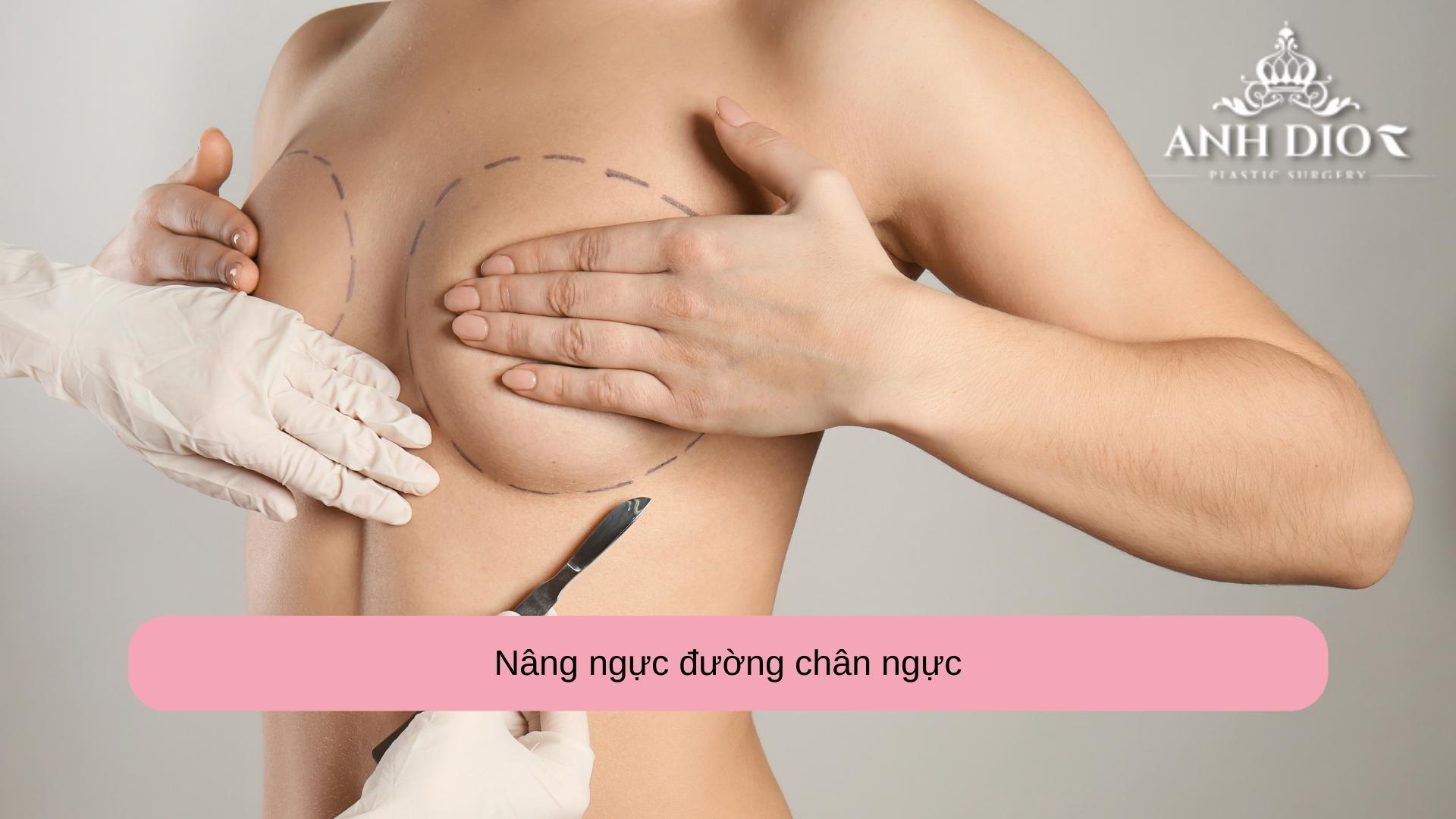 Nâng ngực đường chân ngực