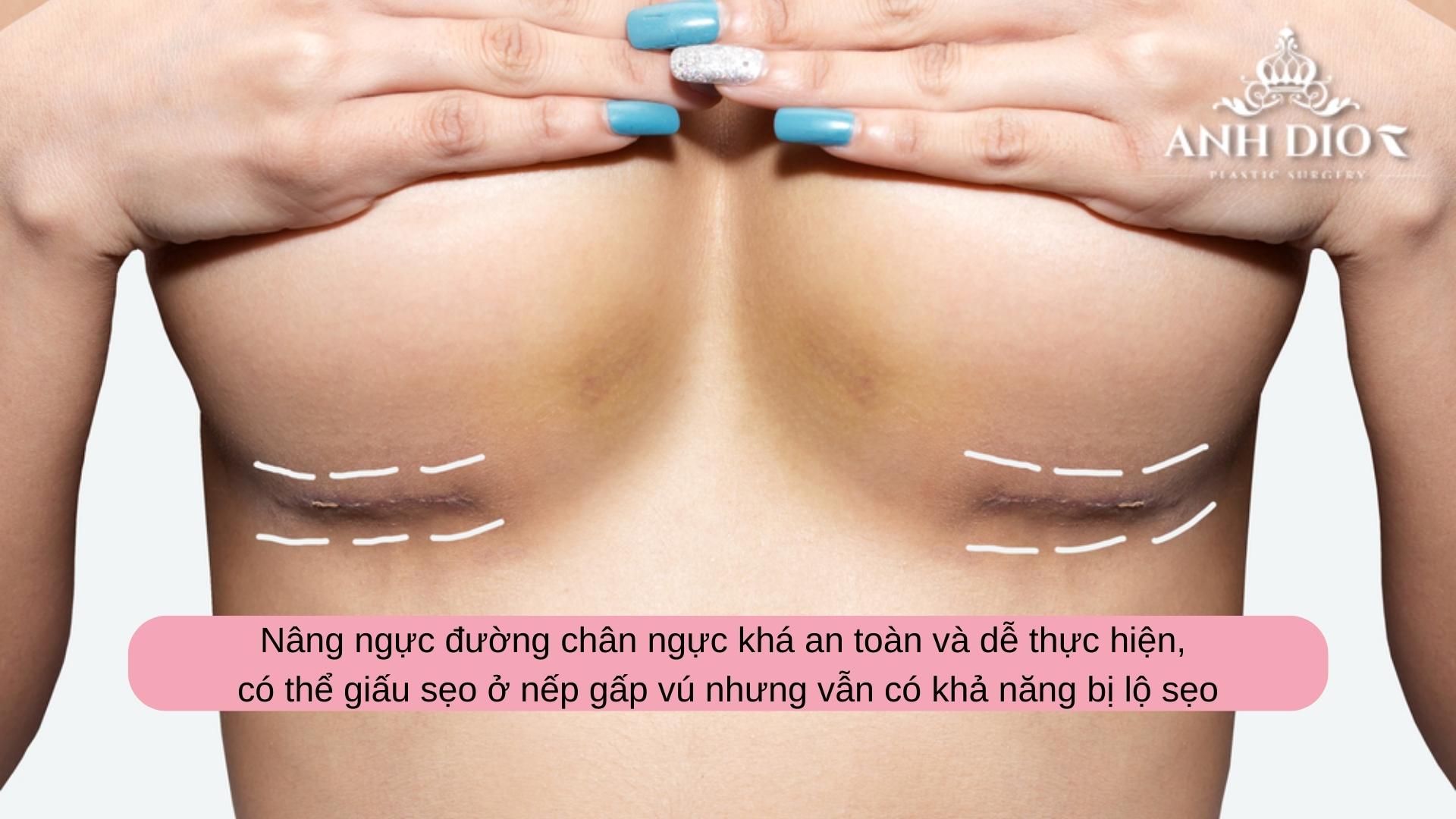 Nâng ngực đường chân ngực