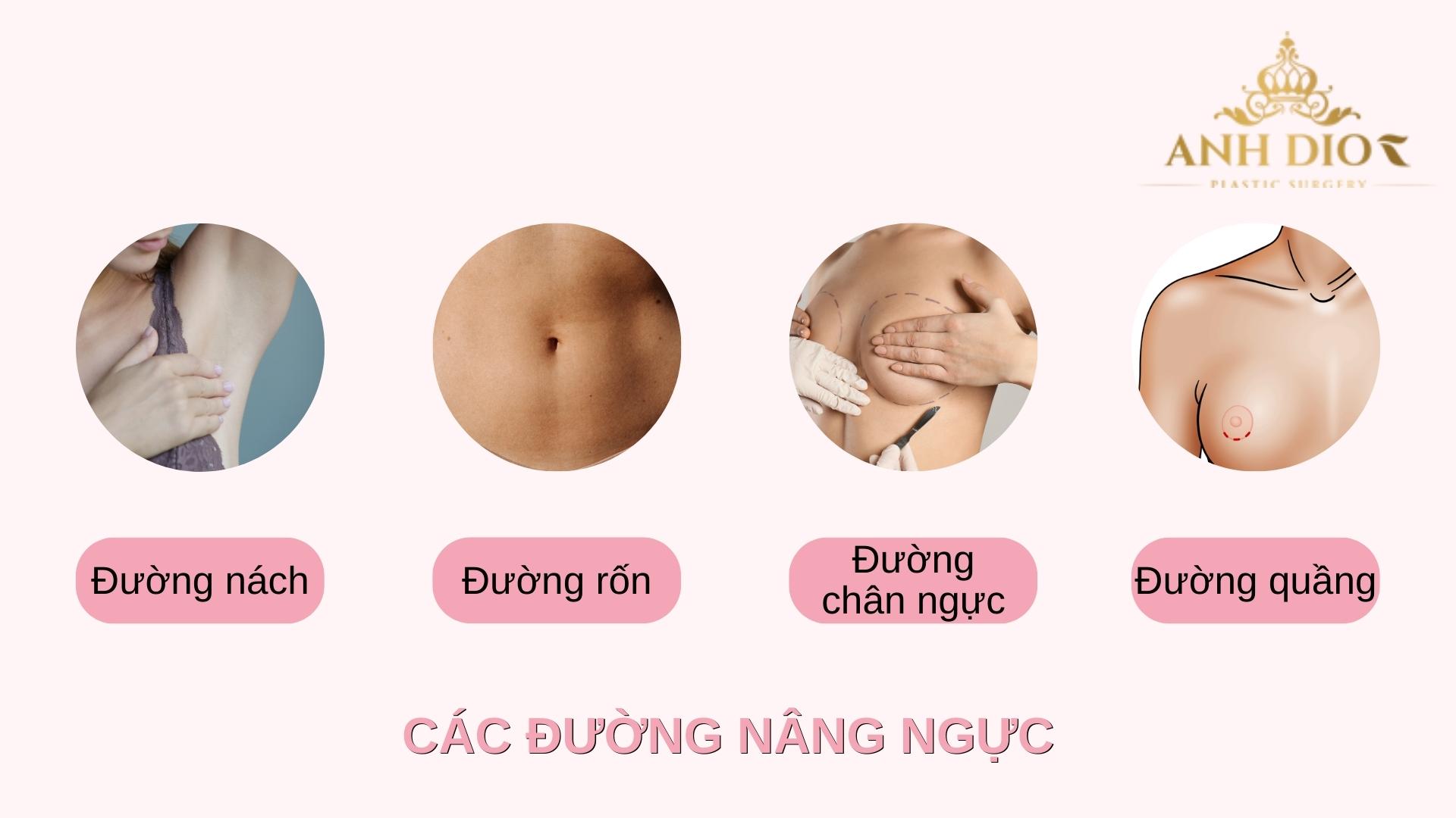 Nâng ngực đường nào tốt nhất