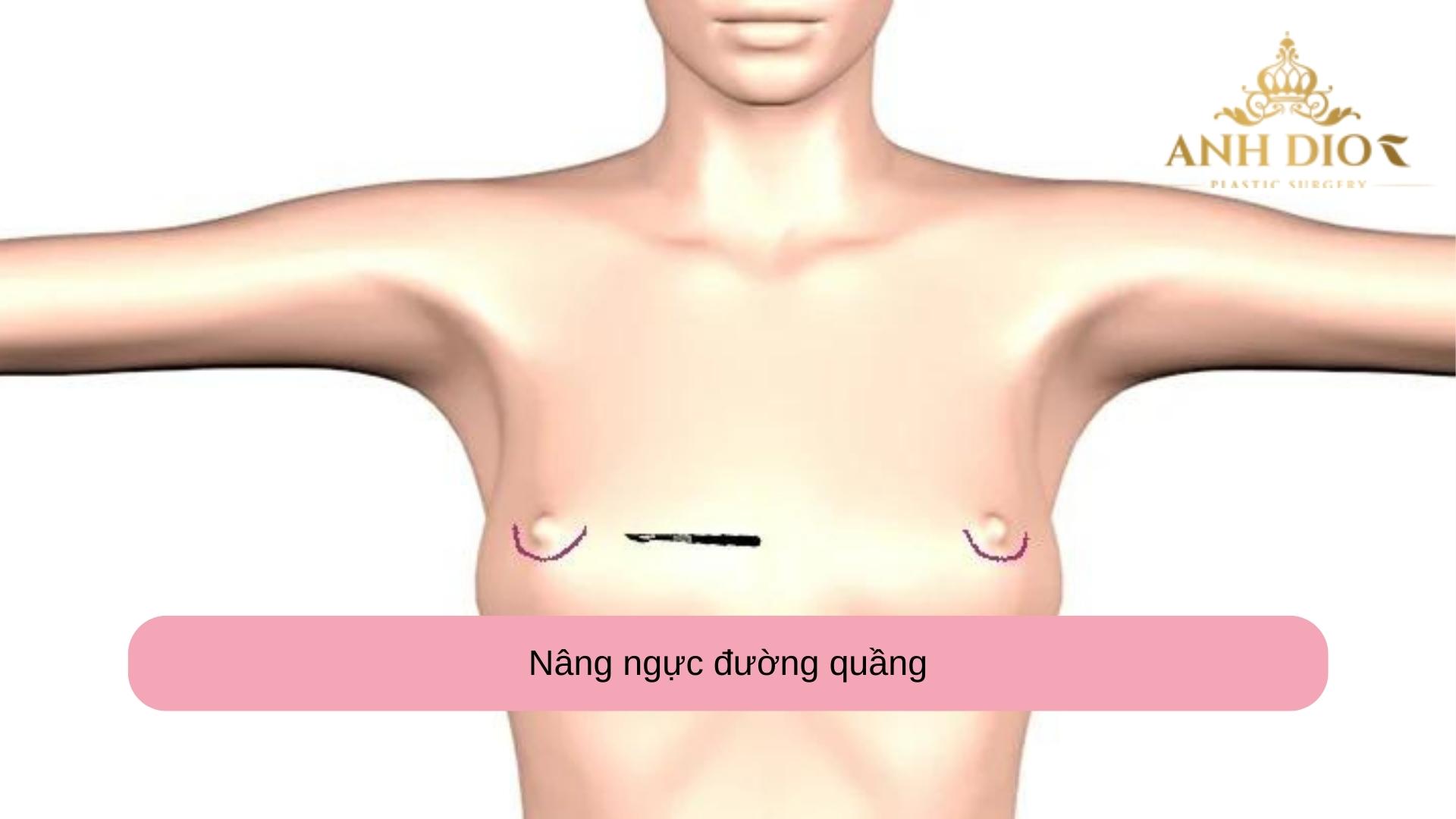 Nâng ngực đường quầng