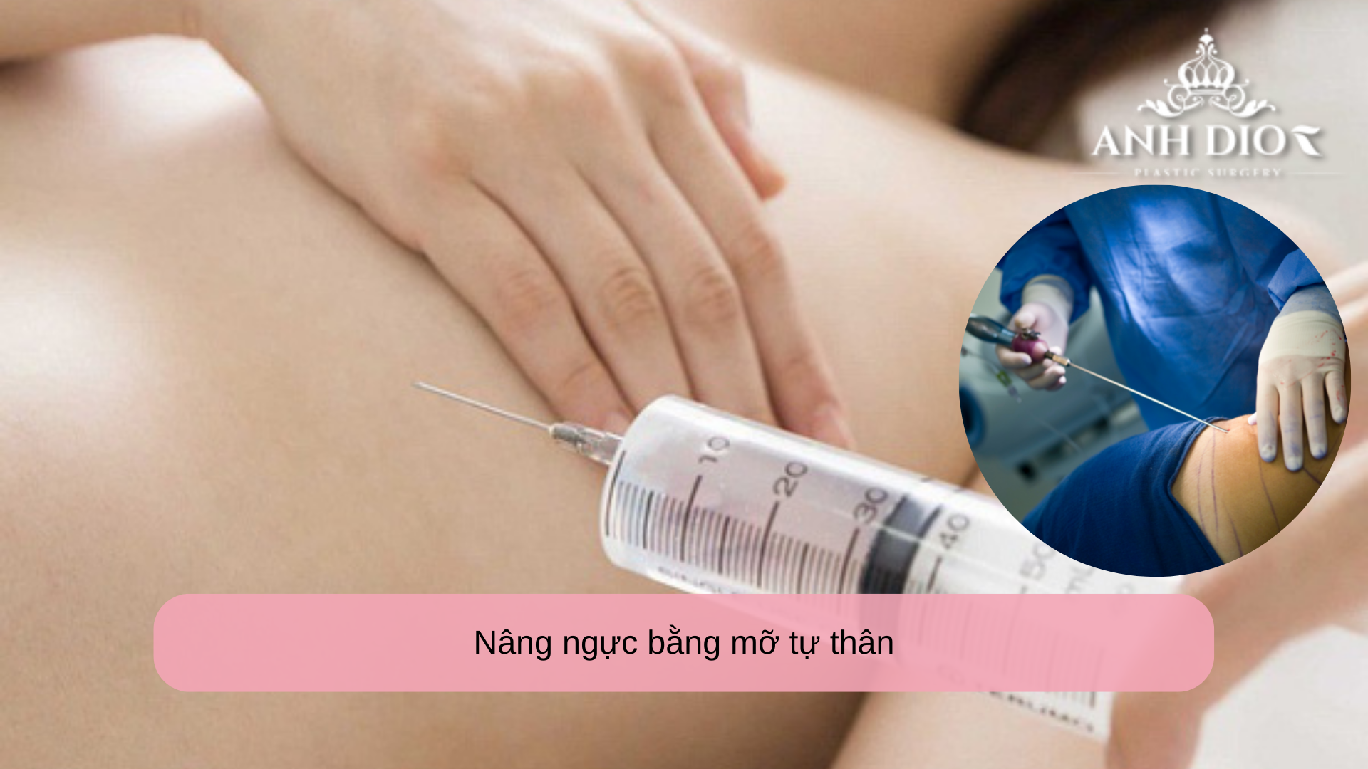 Các loại nâng ngực