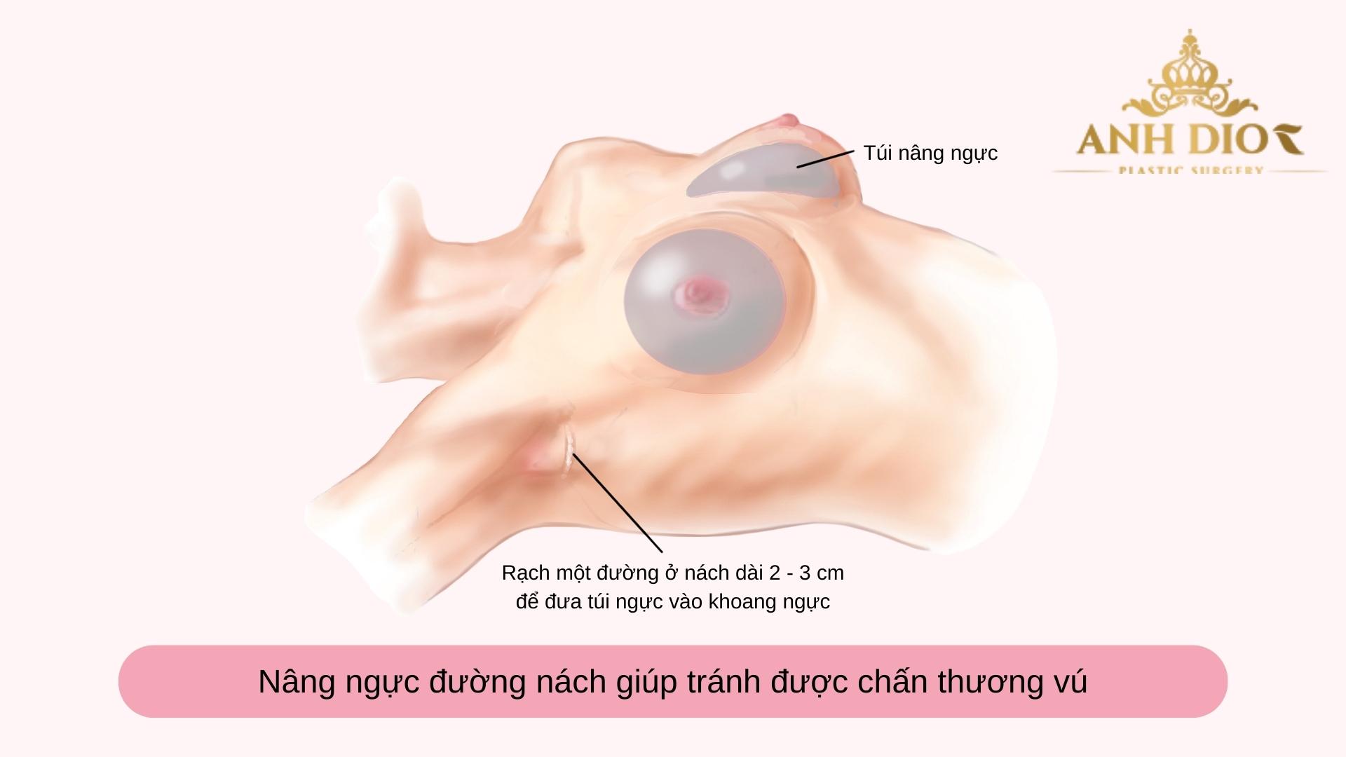 Nâng ngực xong có cho con bú được không