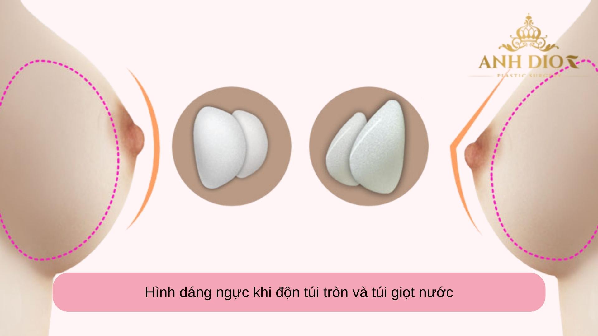 Nên nâng ngực túi tròn hay túi giọt nước