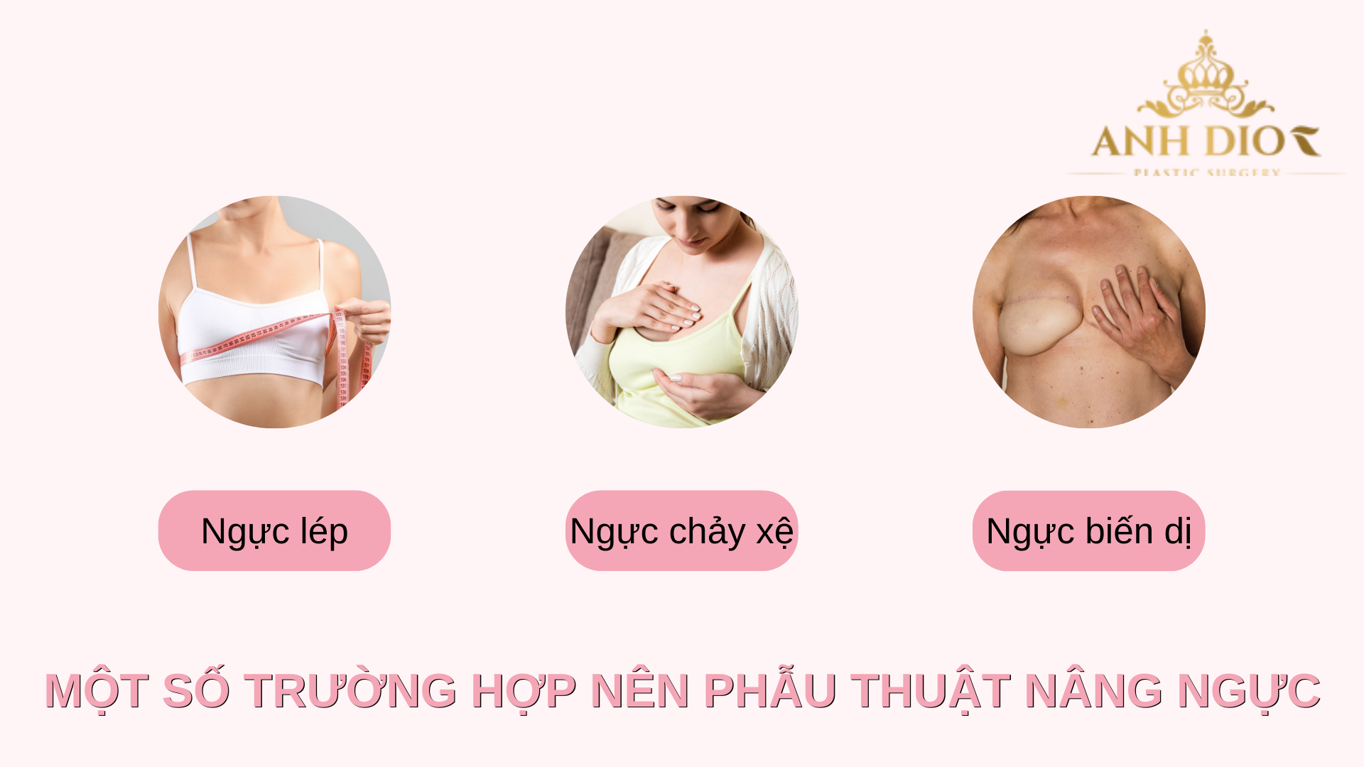 Phẫu thuật nâng ngực