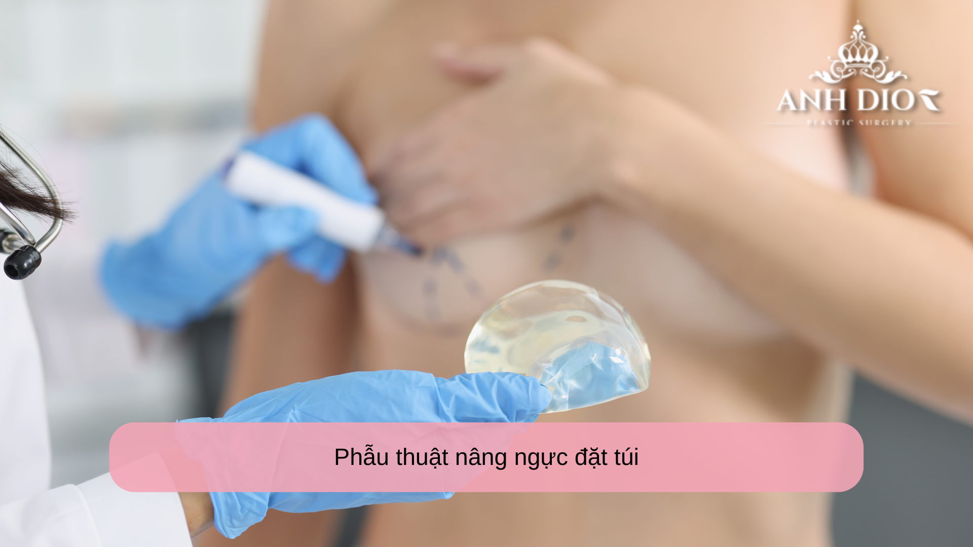 Phẫu thuật nâng ngực