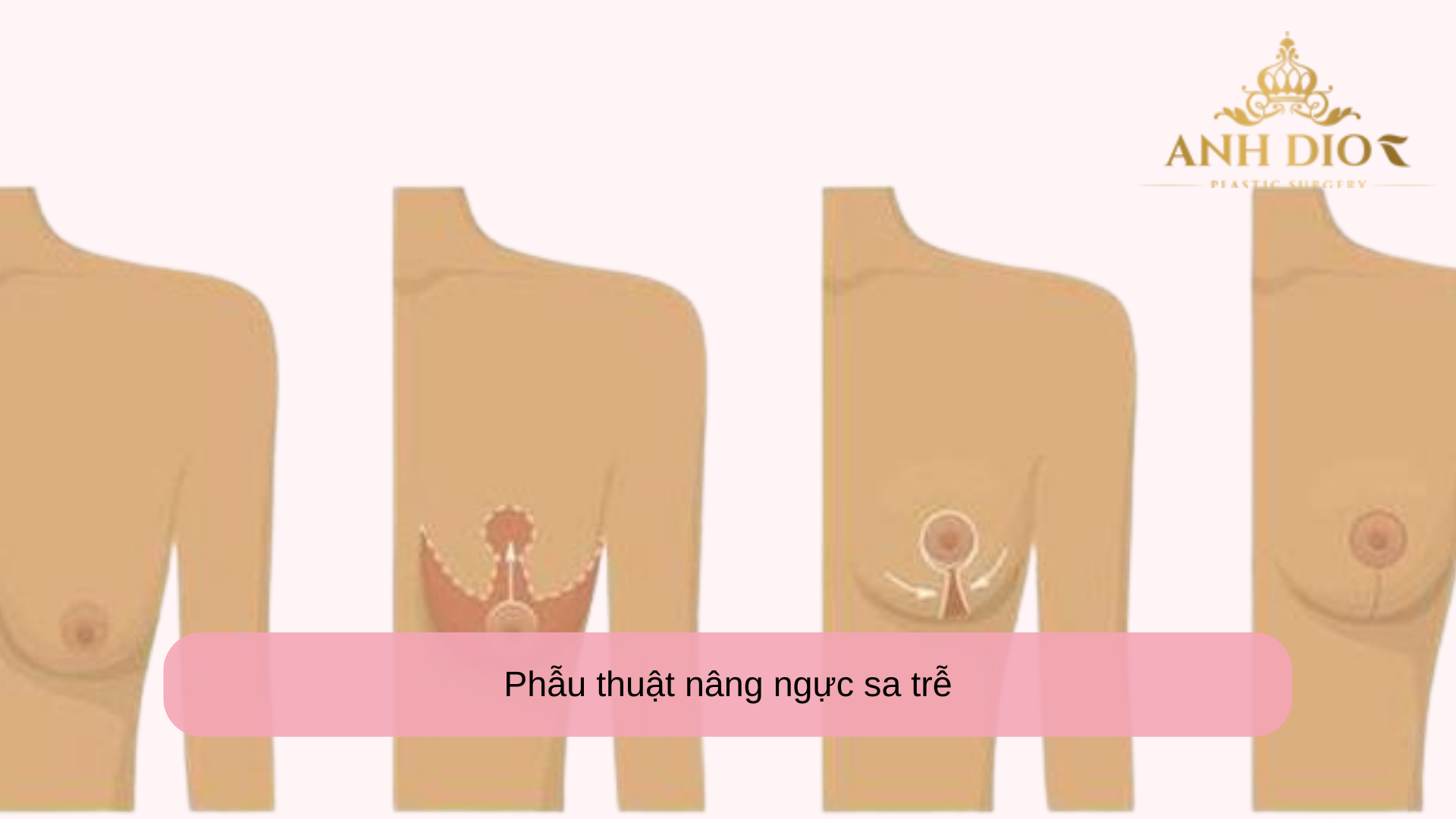 Phẫu thuật nâng ngực